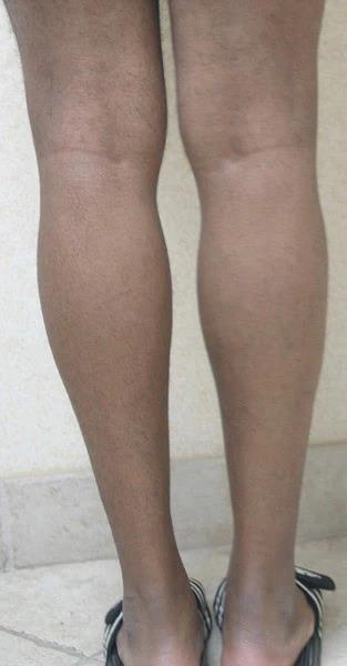 Calf Augmentation With Fat Before Back Legs Two by Dr Grossman in NY US