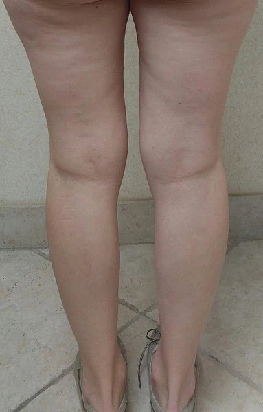 Calf Augmentation With Fat Before Back Legs by Dr Grossman in NY US