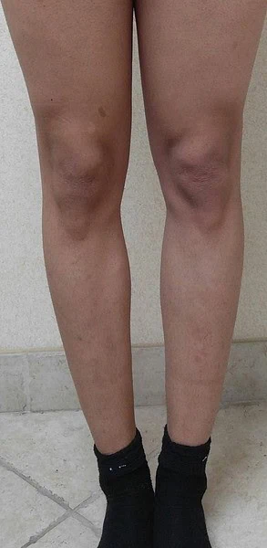 Calf Augmentation With Fat Before Front Legs Five by Dr Grossman in NY US