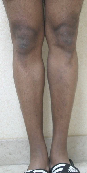 Calf Augmentation With Fat Before Front Legs Two by Dr Grossman in NY US