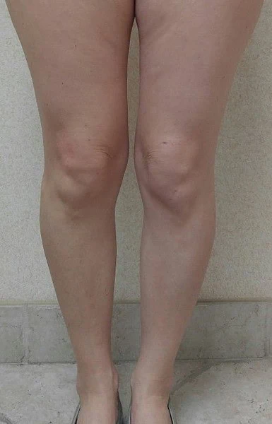 Calf Augmentation With Fat Before Front Legs by Dr Grossman in NY US