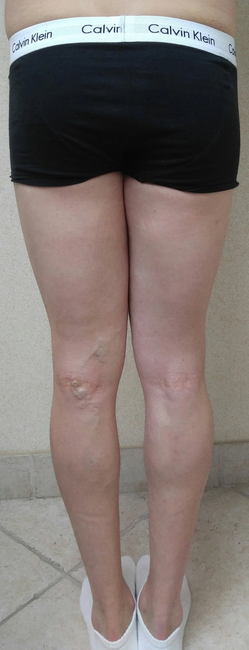 Calf Augmentation With Fat Before Two by Dr Grossman in NY US