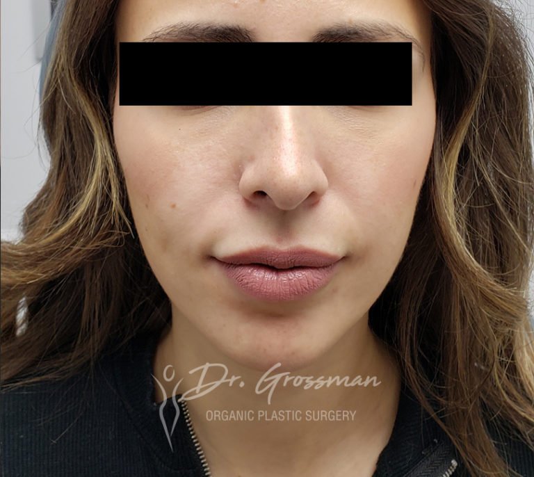 Facial Rejuvenation Before & After Images In New York
