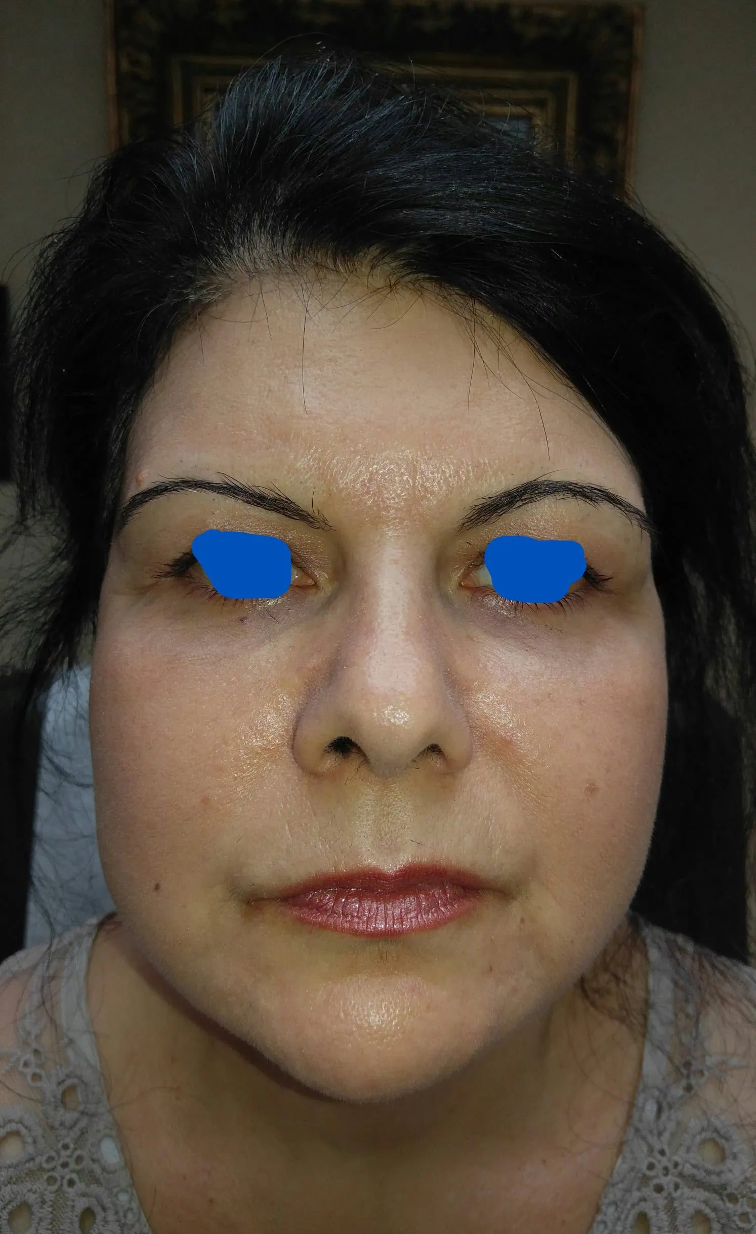 Fat Transfer With Facial Rejuvenation After by Dr Grossman in NY US