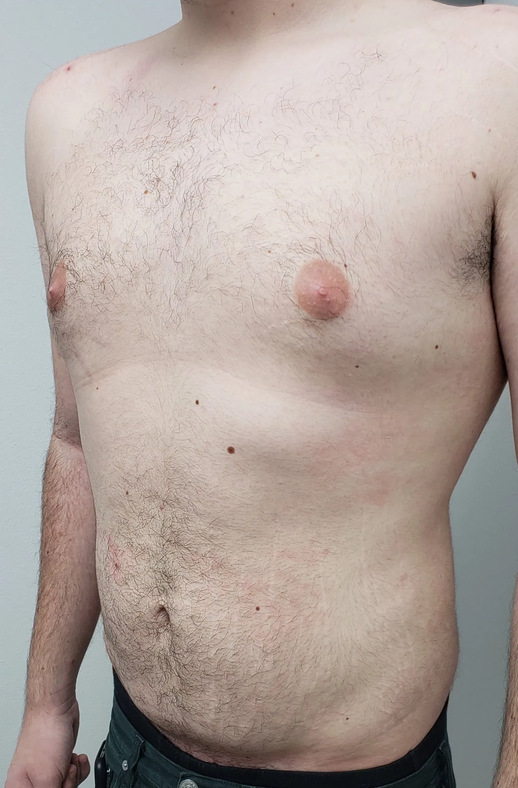 Gynecomastia Liposuction Cosmetic Surgery After Two by Dr Grossman in NY US scaled