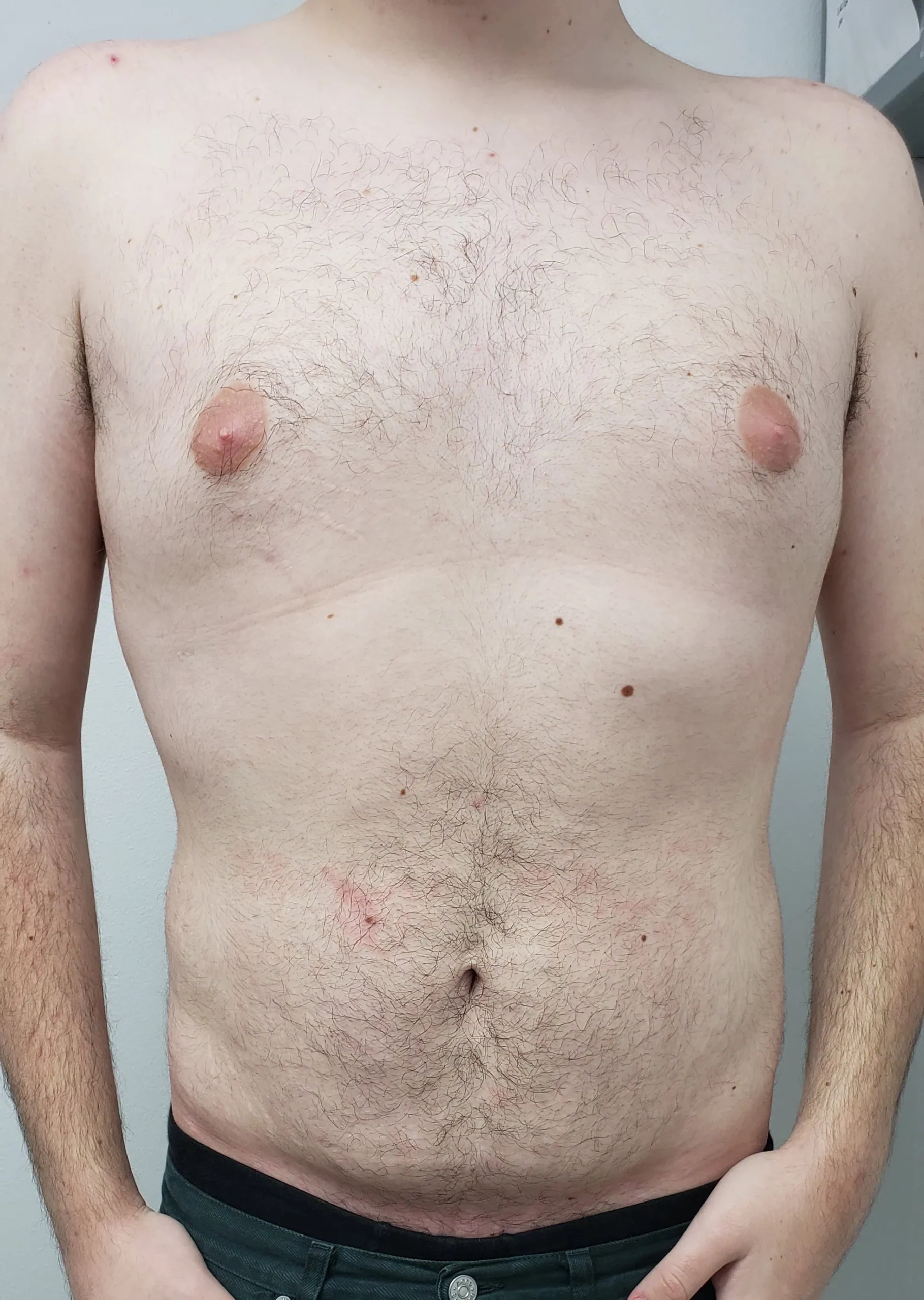 Gynecomastia Liposuction Cosmetic Surgery After by Dr Grossman in NY US scaled