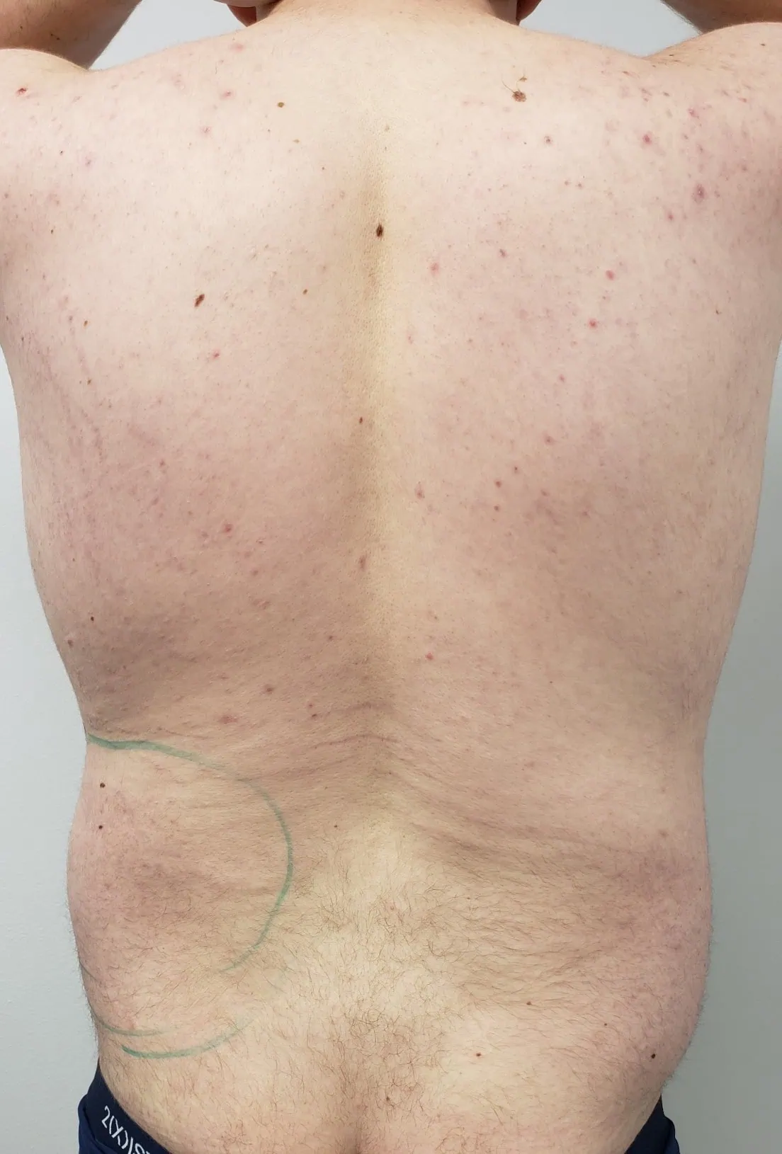 Gynecomastia Liposuction Cosmetic Surgery Before Four by Dr Grossman in NY US