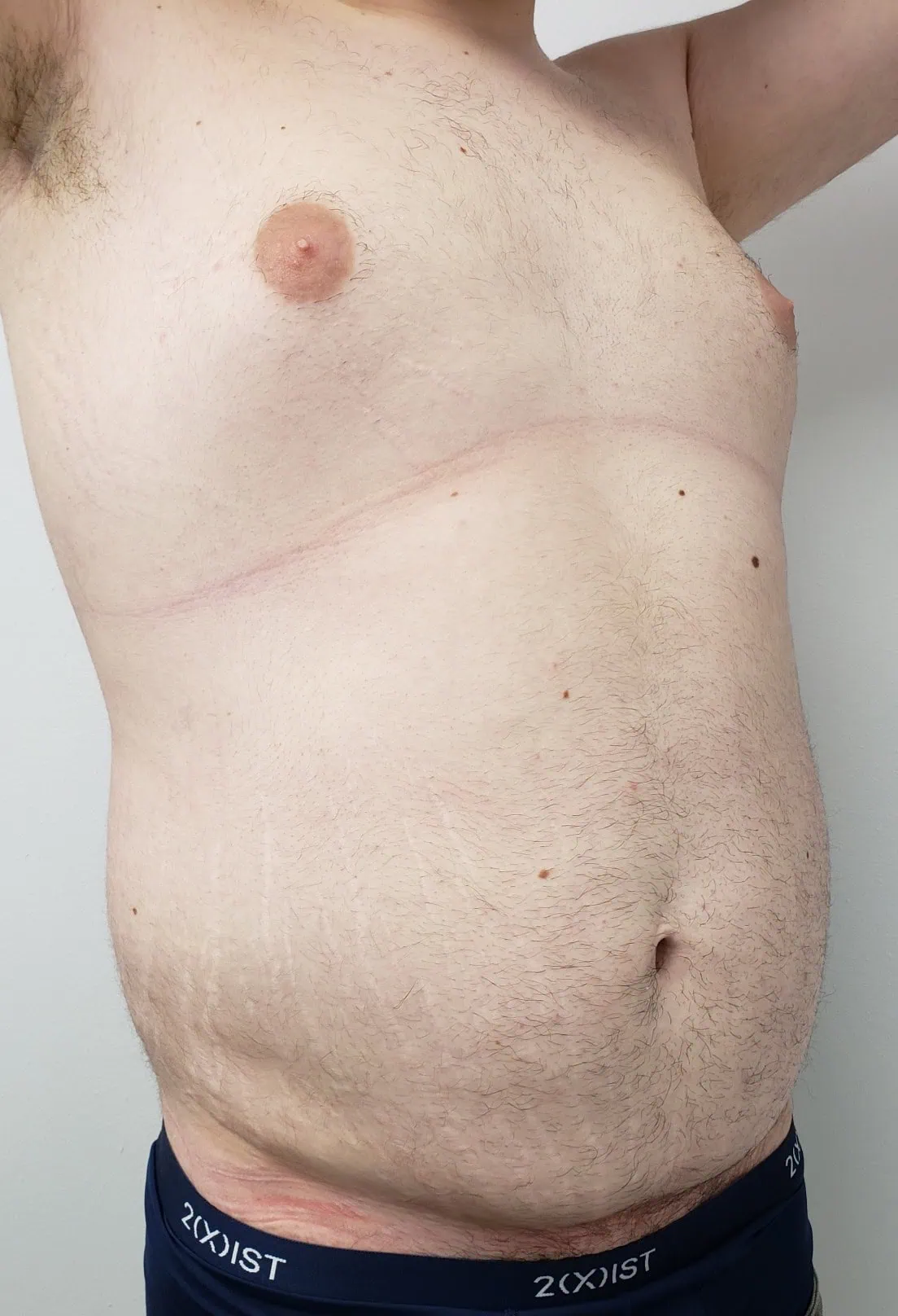 Gynecomastia Liposuction Cosmetic Surgery Before Three by Dr Grossman in NY US