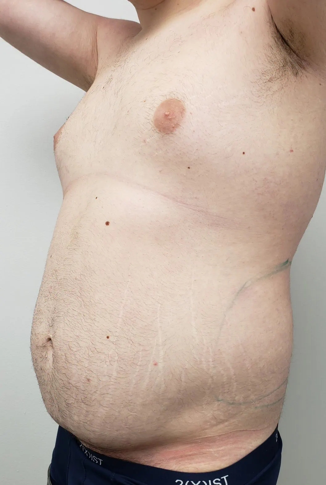 Gynecomastia Liposuction Cosmetic Surgery Before Two by Dr Grossman in NY US