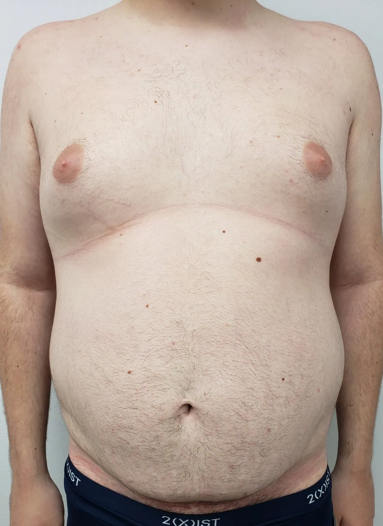 Gynecomastia Liposuction Cosmetic Surgery Before by Dr Grossman in NY US