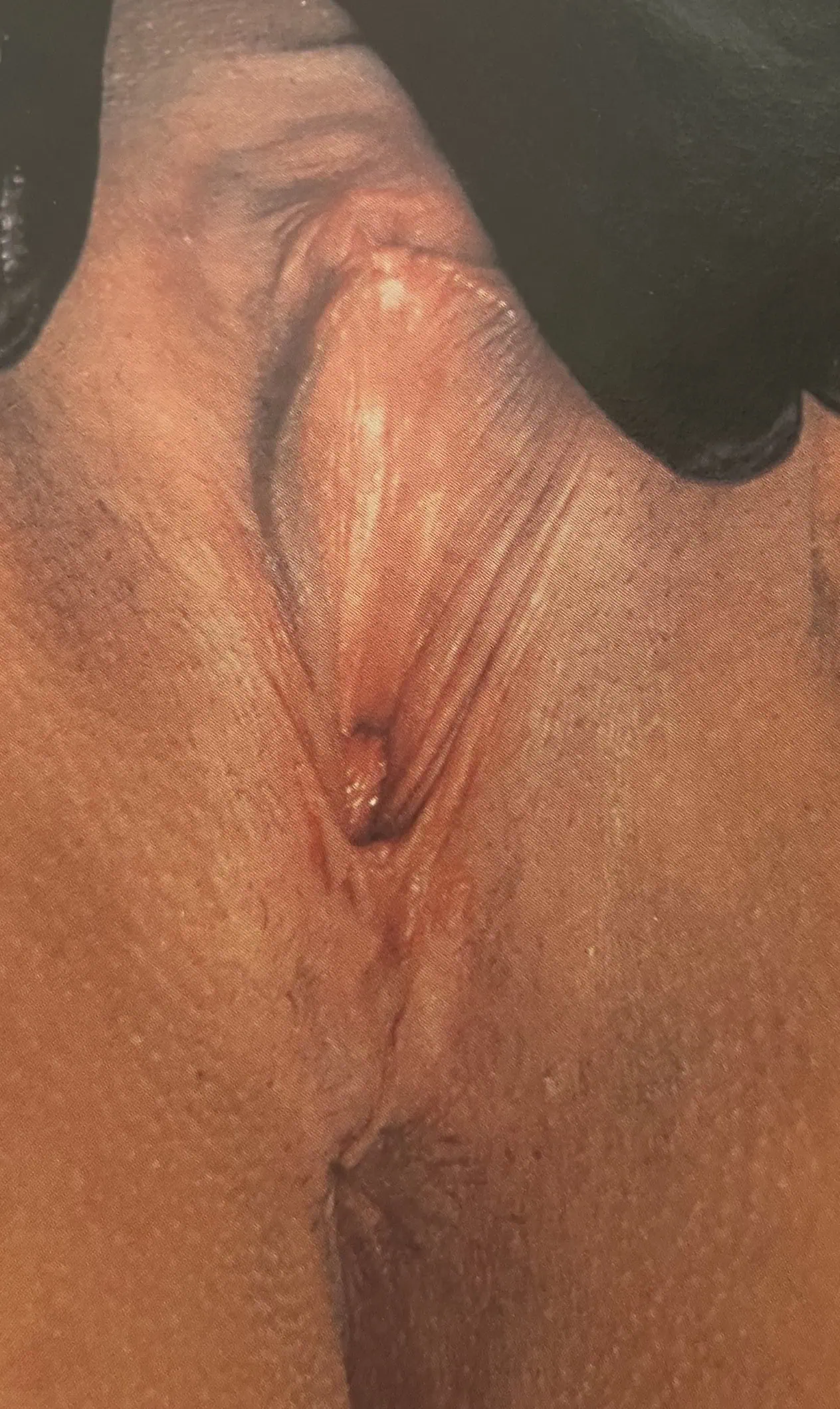 Labiaplasty After by Dr Grossman in NY US