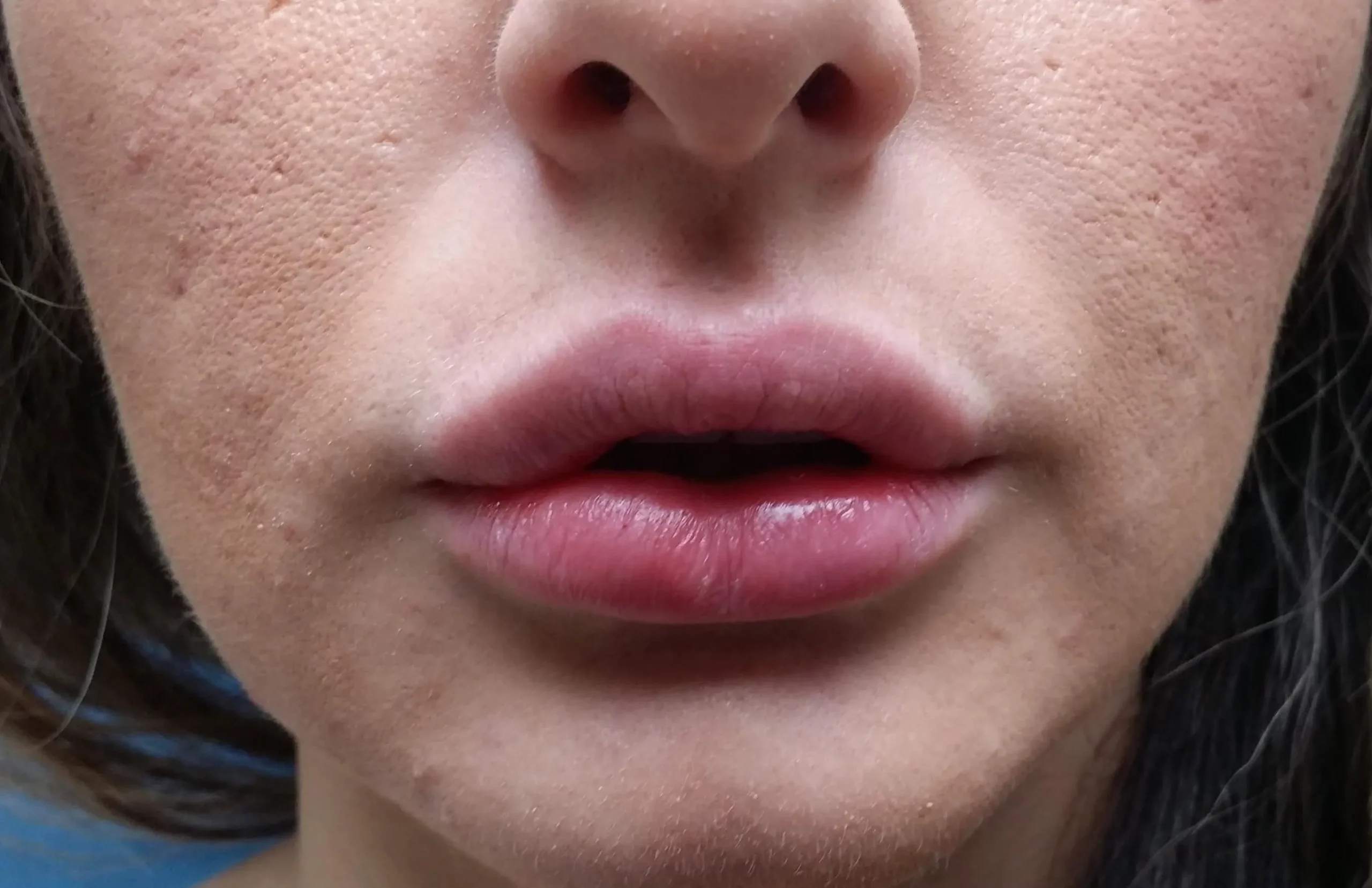 Lip Augmentation After by Dr Grossman in NY US scaled