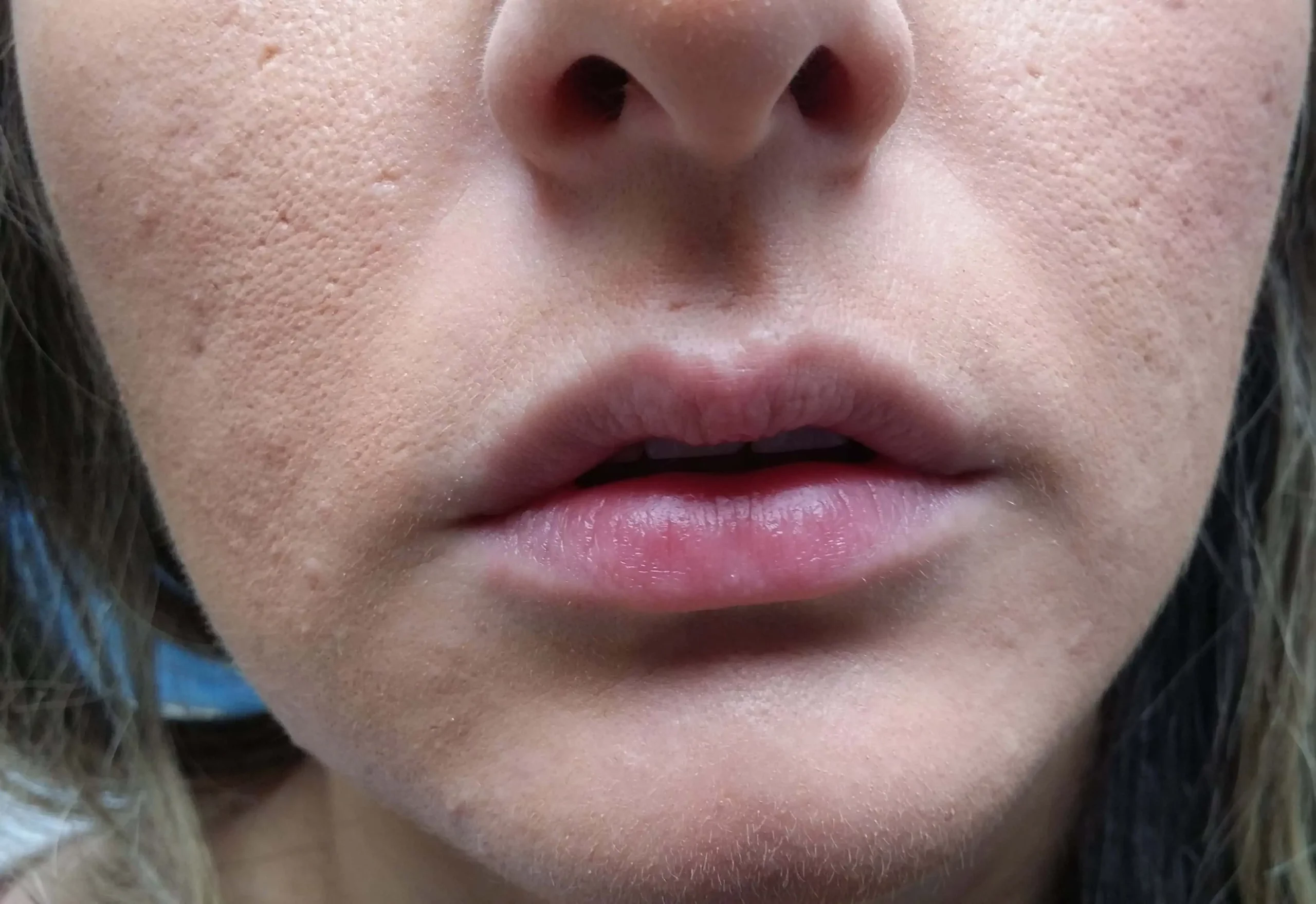 Lip Augmentation Before by Dr Grossman in NY US scaled