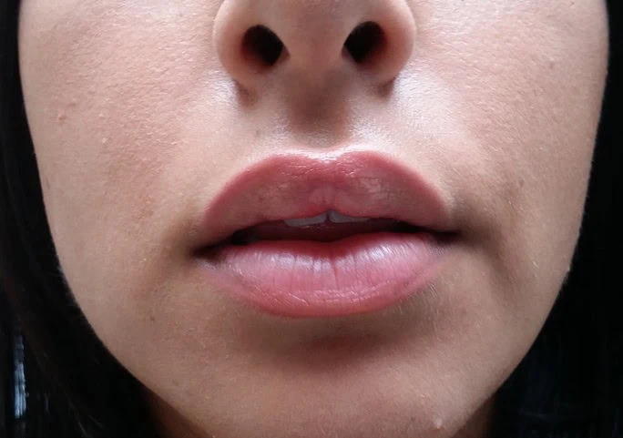 Lip Augmentation Face Front After by Dr Grossman in NY US