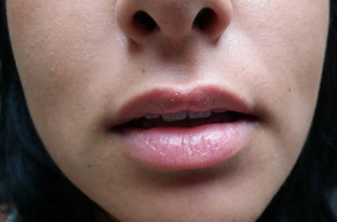 Lip Augmentation Face Front Before by Dr Grossman in NY US