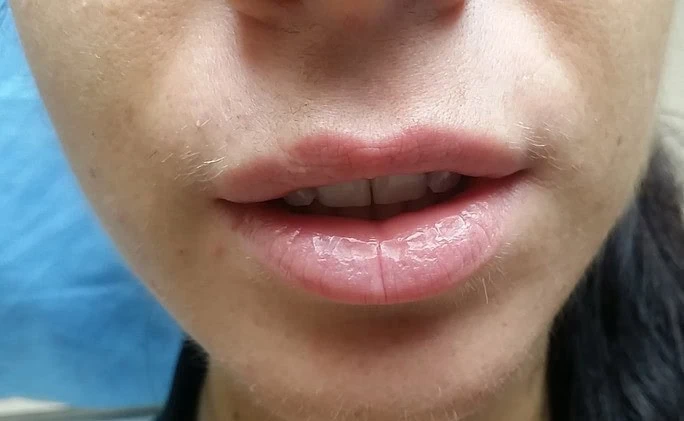 Lip Augmentation Face Front Two Before by Dr Grossman in NY US