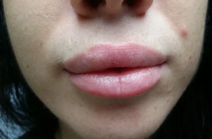 Lip Augmentation Face Lips Front After by Dr Grossman in NY US