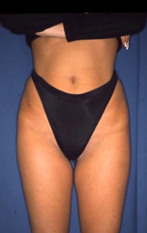 Liposuction After One by Dr Grossman in NY US