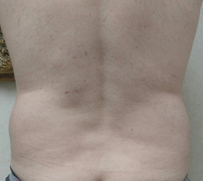 Liposuction Before Four by Dr Grossman in NY US