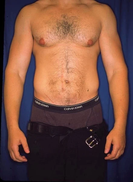 Liposuction Before One by Dr Grossman in NY US 1