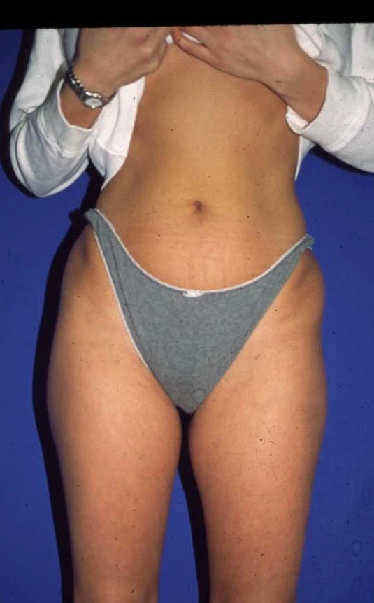 Liposuction Before One by Dr Grossman in NY US