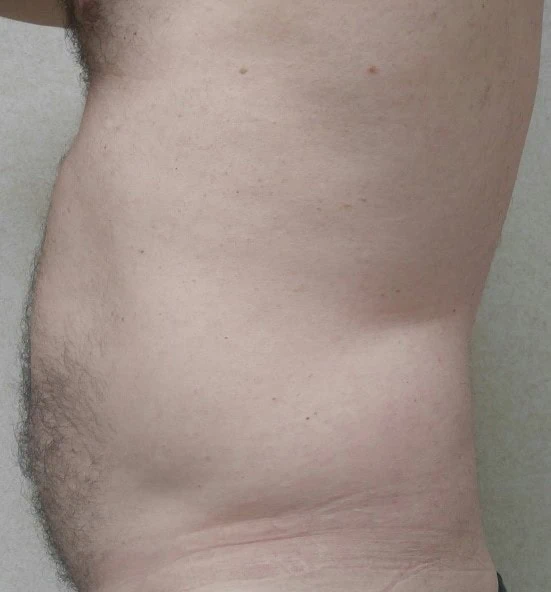 Liposuction Before Three by Dr Grossman in NY US