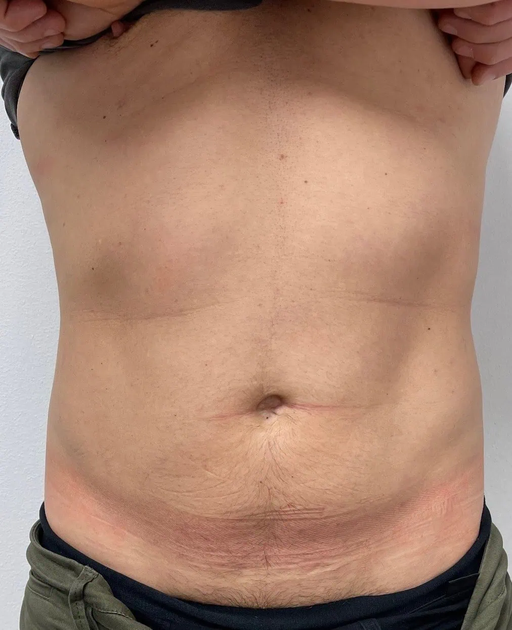 Liposuction Before Two by Dr Grossman in NY US