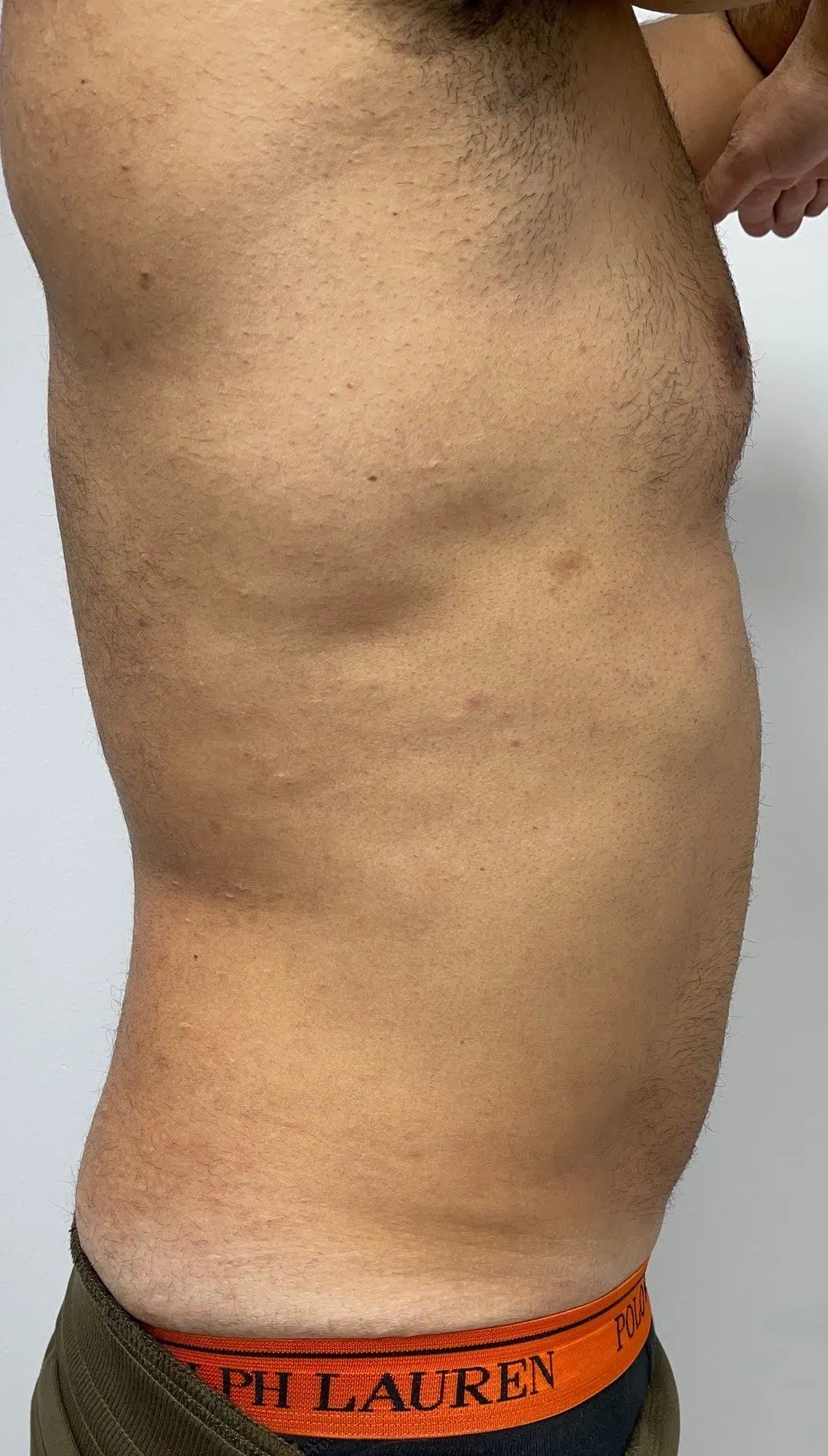 Liposuction Male Plastic Surgery After Three by Dr Grossman in NY US