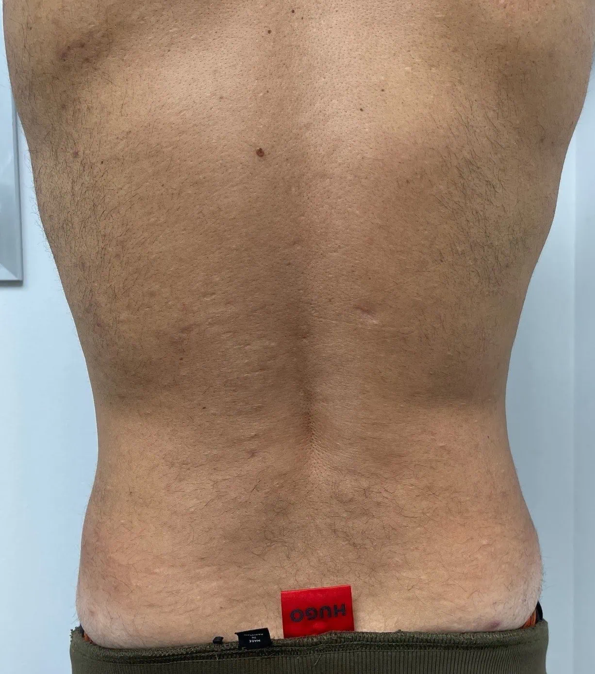 Liposuction Male Plastic Surgery After Two by Dr Grossman in NY US