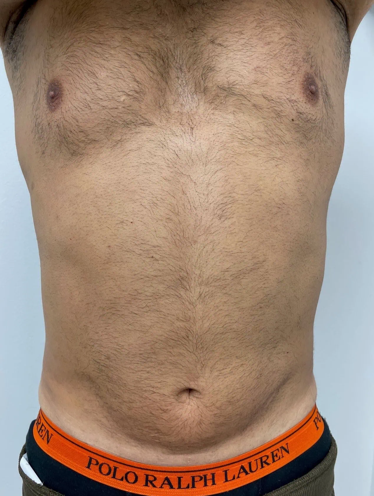 Liposuction Male Plastic Surgery After by Dr Grossman in NY US