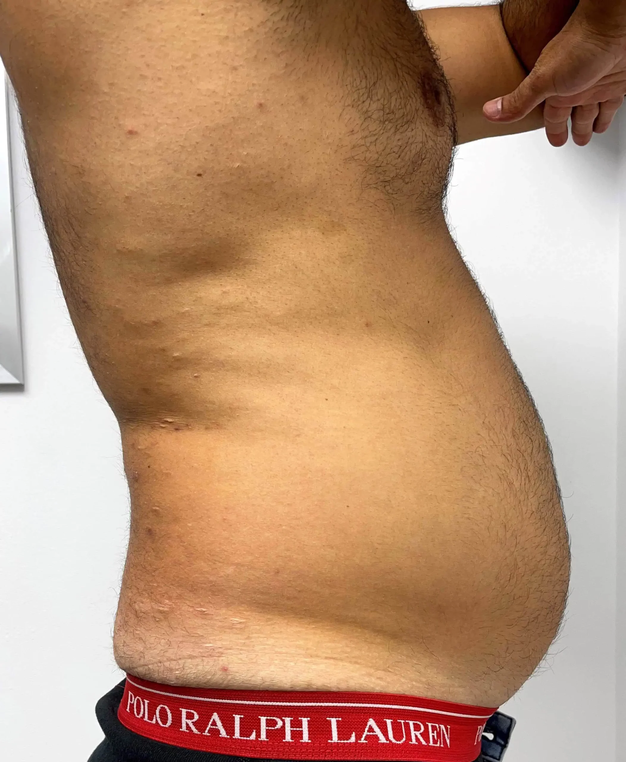 Liposuction Male Plastic Surgery Before Three by Dr Grossman in NY US scaled