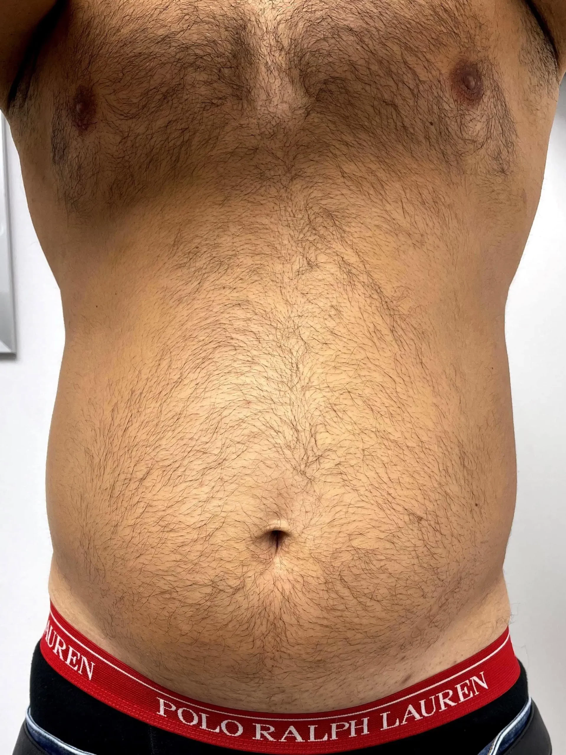 Liposuction Male Plastic Surgery Before by Dr Grossman in NY US scaled