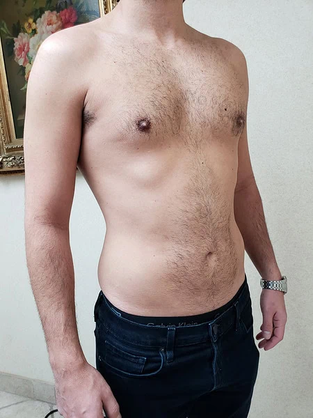 Male Breast Reduction After Side Men by Dr Grossman in NY US