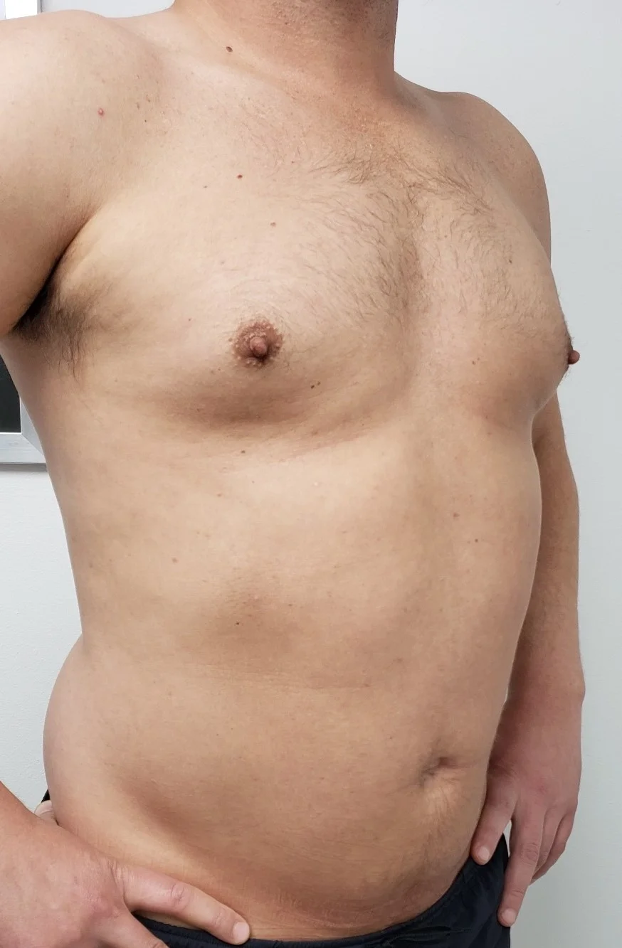 Male Breast Reduction Before 1 by Dr Grossman in NY US