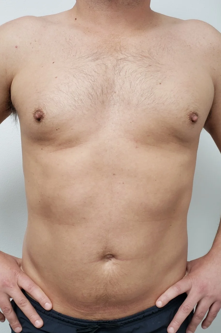 Male Breast Reduction Before 4 by Dr Grossman in NY US