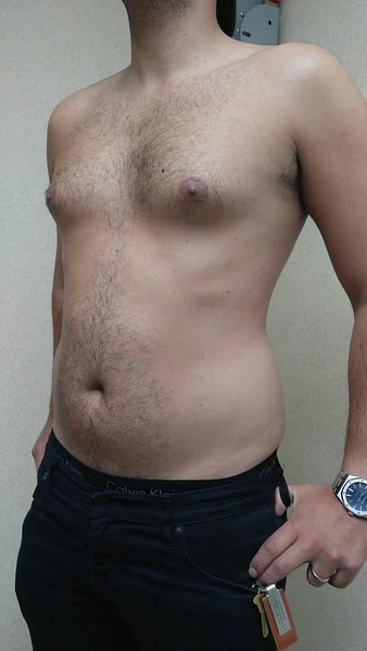 Male Breast Reduction Before Left Side by Dr Grossman in NY US