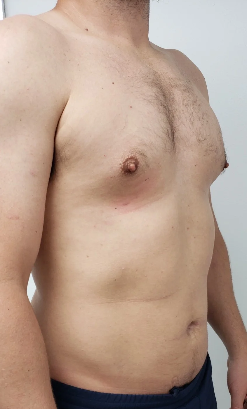 Male Breast Reduction after 1 by Dr Grossman in NY US