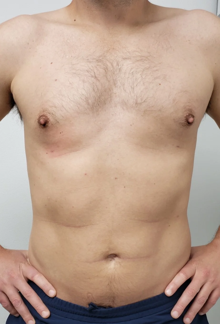 Male Breast Reduction after 4 by Dr Grossman in NY US