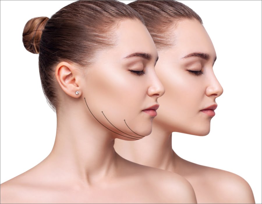 NECK AND CHIN LIPOSUCTION | Dr. Leonard Grossman M.D. | NY