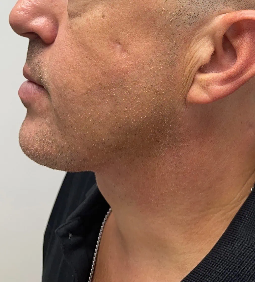 Neck Lift After Three by Dr Grossman in NY US