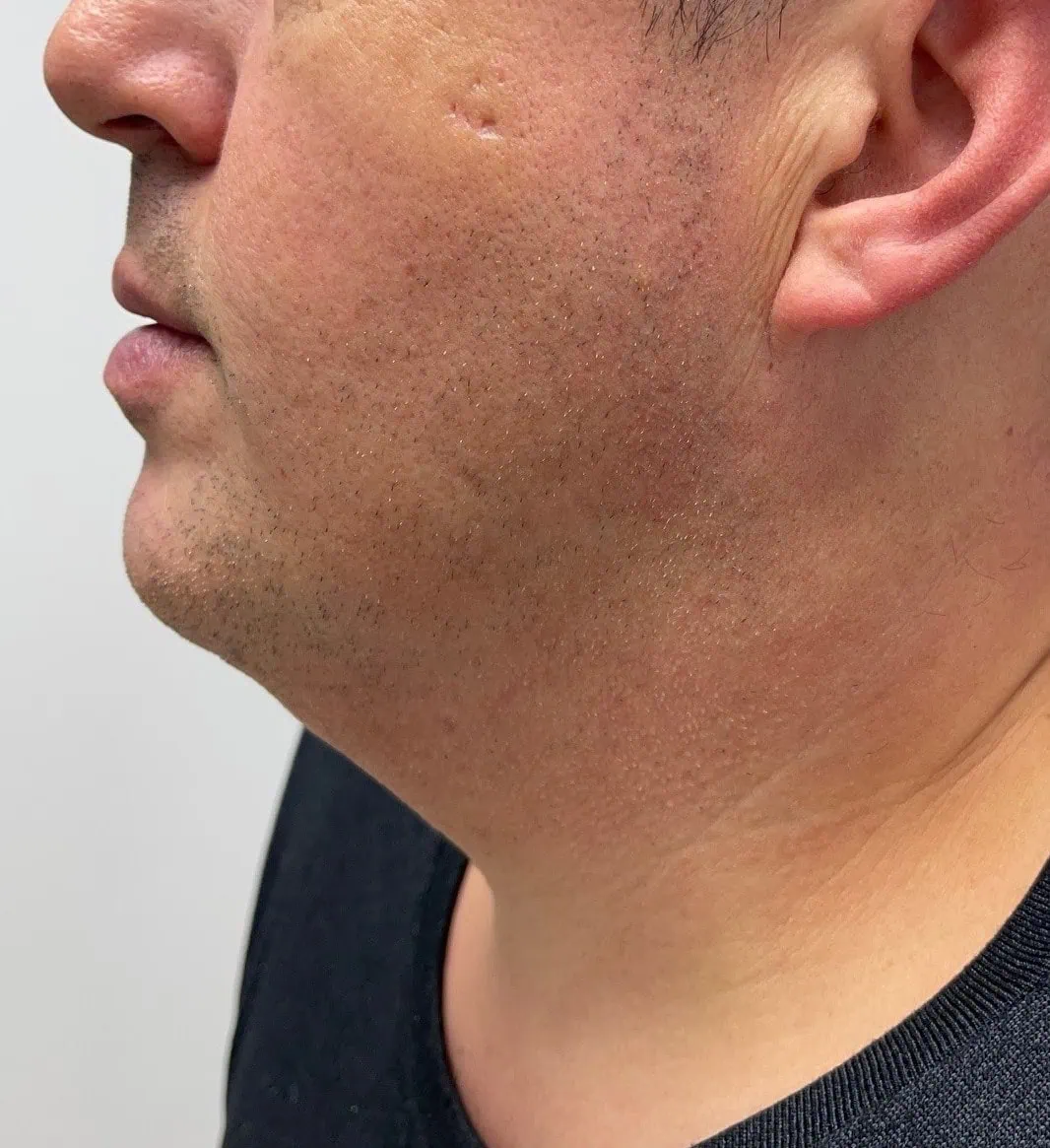 Neck Lift Before Three by Dr Grossman in NY US