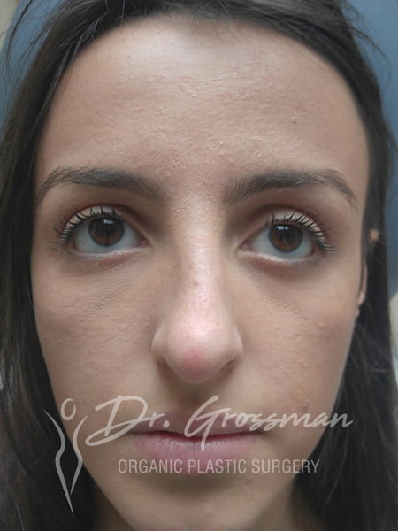 RHINOPLASTY3 2