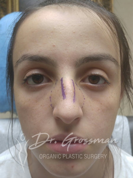 RHINOPLASTY4 2