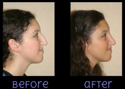 Rhinoplasty After Before by Dr Grossman in NY US