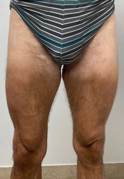 Thigh Lift Front After by Dr Grossman in NY US