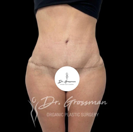 Tummy Tuck before and after drgrossman.jpg aaa