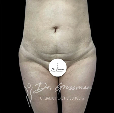 Tummy Tuck before and after drgrossman