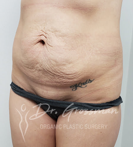 Tummytuck2 before