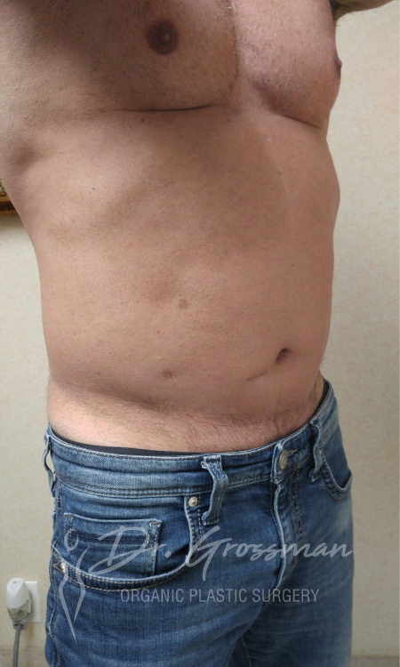 Abdominal etching Treatment | New York City Plastic Surgery PC