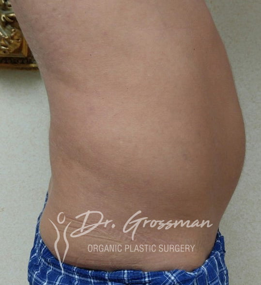 abdominal etching drgrossman before 1